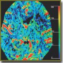 Change in Cerebrovascular Resistance as Diagnostic Index of Cerebral Hemodynamics in Patients with Severe Combined Traumatic Brain Injury