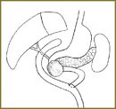 Two-stage Treatment of Complicated Duodenal Cancer