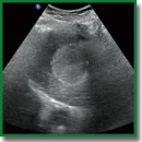 Criteria for Selecting the Optimal Method of Treating Hepatic Hemangiomas