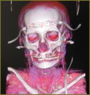 The Use of Cerebral Oximetry in Acute Period of Severe Polytrauma