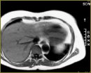 Actual Radiodiagnosis Technologies of Hepatic Cancer