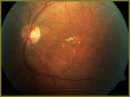 The Use of Optical Coherent Tomography to Research the Efficacy of Treatment of Patients with Diabetic Retinopathy Using Pijavitum