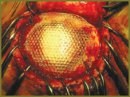 Plasty of the Base of the Skull Defects and Dura Mater with the Reperen’s New Polymer Material