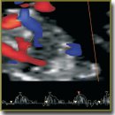 Normative Values of Doppler Parameters of Blood Flow in the Fetal Hepatic Artery of Normal Karyotype Fetuses at 11–14 Weeks Gestation