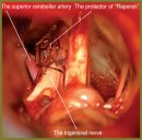 The Use of Protector Made of Reperen in Microvascular Decompression of Trigeminal Nerve