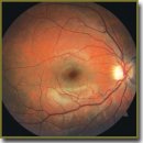 Macular Pigment Optical Density Alteration as an Indicator of Diabetic Macular Edema Development
