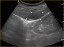 The Emprovement of Percutaneous Puncture Core Renal Biopsy in Diffuse Diseases
