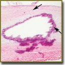 Quantitative Evaluation of the Polarization Characteristics of Coronary Arteries Atherosclerotic Plaques at Different Development Stages