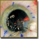 Phacoemulsification of Cataract in Patients Undergone Anterior Radial Keratotomy