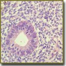 Evaluating the Efficiency of Immunohistochemical Methods  in Diagnosis of Endometrial Status in Women with Uterine Infertility