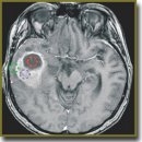 Ex vivo Visualization of Human Gliomas with Cross-Polarization Optical Coherence Tomography: Pilot Study