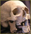 The Opportunities of Modern Radiodiagnostic Methods in Expert Evaluation of Anthropological Material