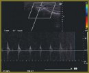A Case of Transcranial Duplex Scanning of Cerebral Arteries in a Patient with Neurotrauma