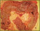 Case of the Crohn’s Disease Acute Attack at a Peroral Poisoning  with Electrolyte