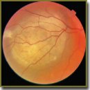 The Role of Pathologic and Molecular Genetic Factors in Development of Uveal Melanoma Extrabulbar Growth