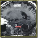 A Case of Three-Stage Treatment of Bilateral Synchronous Renal Carcinoma with Metastatic Brain Lesions