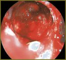 Retinated 28th Tooth in a Maxillary Sinus — a Rare Observation  in a Practice of Otorhinolaryngologist