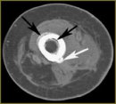 Radiodiagnosis of the Residual Lower Limb Changes in Prosthetic Repair