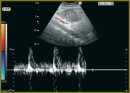 The Experience of Using Ultrasound in Differential Diagnostics of Difficult Cases of Urgent Surgery (Mesenteric Thrombosis and Destructive Pancreatitis)