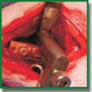 Scaffolds Based on Poly(3-Hydroxybutyrate) and Its Copolymers for Bone Tissue Engineering (Review)
