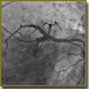 Application of Percutaneous Coronary Sinus Occlusion in Patients with Acute Coronary Syndrome Without Hemodynamically Significant Atherosclerotic Coronary Lesions