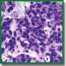 Drug-Induced Pathomorphosis of Glioblastoma 101.8 in Wistar Rats Treated with Doxorubicin Bound to Poly(lactide-co-glycolide) Nanoparticles