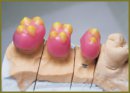 Reduction of the Fixed Prosthesis Occlusive Surface Considering  the Patient’s Age