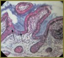 New Criteria for Prediction and the Assessment of Effective Therapy of Ulcerative Colitis in Children