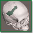 Rekost-M Bone Replacement Implants Based on 3D Modeling for Closing Post-Craniotomy Skull Defects: Pre-Clinical and Clinical Studies