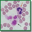Associations of Toll-like Receptor Gene Polymorphisms with NETosis Activity as Prognostic Criteria for the Severity of Pneumonia