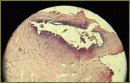 OCT Laparoscopy in the Diagnosis of “Minor Forms” of Endometriosis