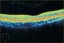 Leber Hereditary Optic Neuropathy