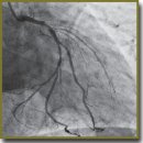 Novel Technique of Endovascular Retrograde Circulatory Support in Patients with Acute Coronary Syndrome: Emphasis on Myocardium Functional State