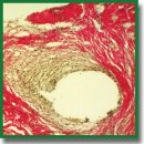 Antithrombotic Suture Modification: Long-Term Storage Stability