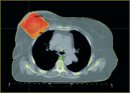 Effectiveness of Radiotherapy Techniques After Breast-Conserving Surgery in Patients with Early Breast Cancer