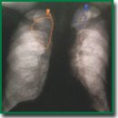PhthisisBioMed Artificial Medical Intelligence: Software for Automated Analysis of Digital Chest X-ray/Fluorograms