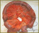 Case of a Venous Mesenteric Thrombosis Successful Operative Treatment