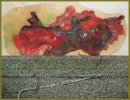 Selective Embolization as a Pre-operational Aid in Patient  with a Small Pelvis Recurrent Tumor