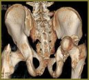 Radiodiagnosis of Concomitant Injury of Pelvis Resulted from Falling from Height