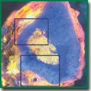 Visualization of Gastric Adenocarcinoma Lymph Node Metastases by Microscopy with Ultraviolet Surface Excitation