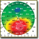 Femtosecond Corneal Collagen Crosslinking in Treatment of Patients with Progressive Keratoconus Stages I–II
