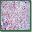 Hypoxic Preconditioning of the Skin Graft Donor Area: Clinical and Morphological Assessment