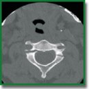 Experience of Using Transpedicular Osteosynthesis in Traumatic Spondylolisthesis of the Axis