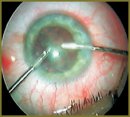 New Technologies of a Lens Refractive Substitution with a Use  of Microincisions