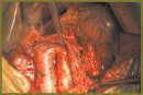 Extensive Gastropancreatoduodenal Resections in the Treatment of Ductal Carcinoma of the Head of Pancreas