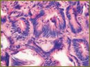 The Use of a Local Effect of a Superhigh Frequency (SHF) Energy for the Liver Tumor Thermal Destruction (in Clinic)