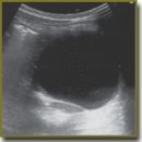Laparoscopic Sclerotherapy  of Child’s Pancreatic Cyst