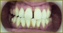 Case of a Chronic Generalized Parodontitis Conservative Treatment with a Use of New Technologies