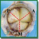 Evaluation of a Failed Heart Valve Bioprosthesis Using Microcomputed Tomography
