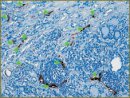 The Experience of Pilot Studies of Lymph Capillaries Pathomorphology of Thyroid Papillary Carcinoma According to the Data from the Images Stained by D2-40 Marker